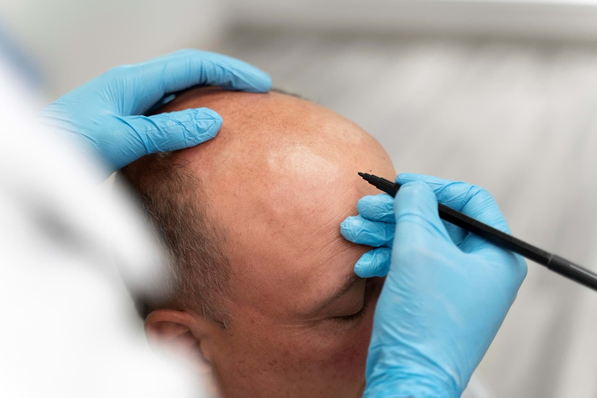 Sapphire Hair Transplantation